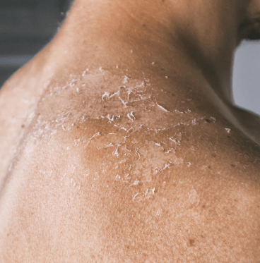 Dry & itching skin problem